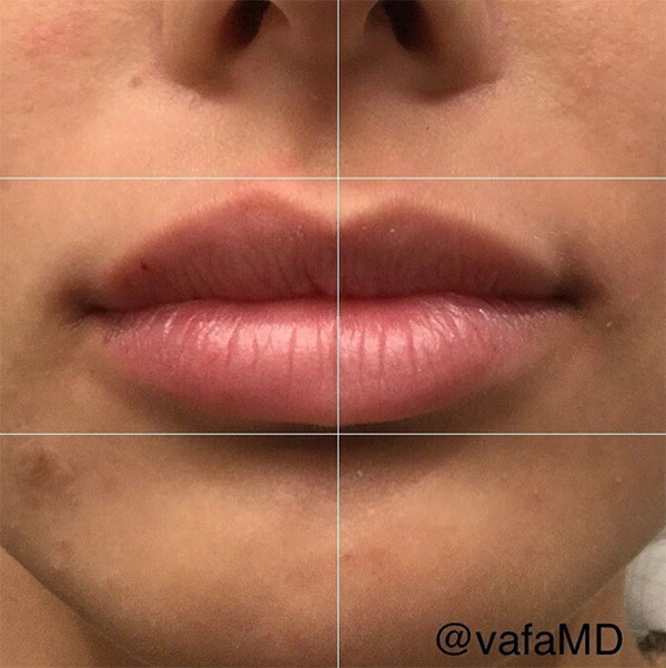 lip enhancement brooklyn before after photos